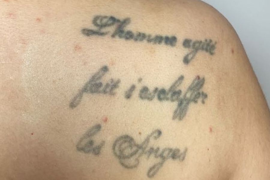 APRES DETATOUAGE LASER une seance