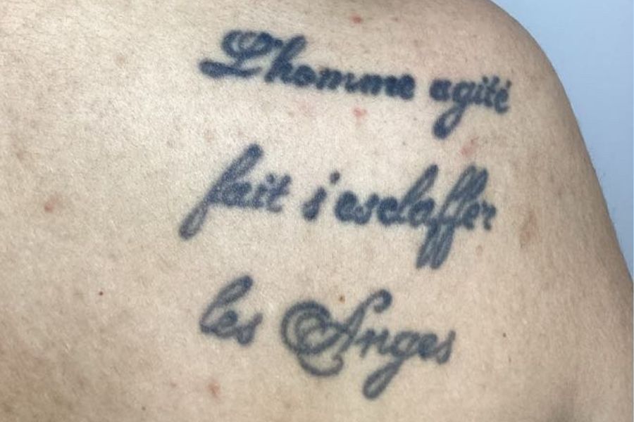 AVANT DETATOUAGE PICOSECONDE LASER