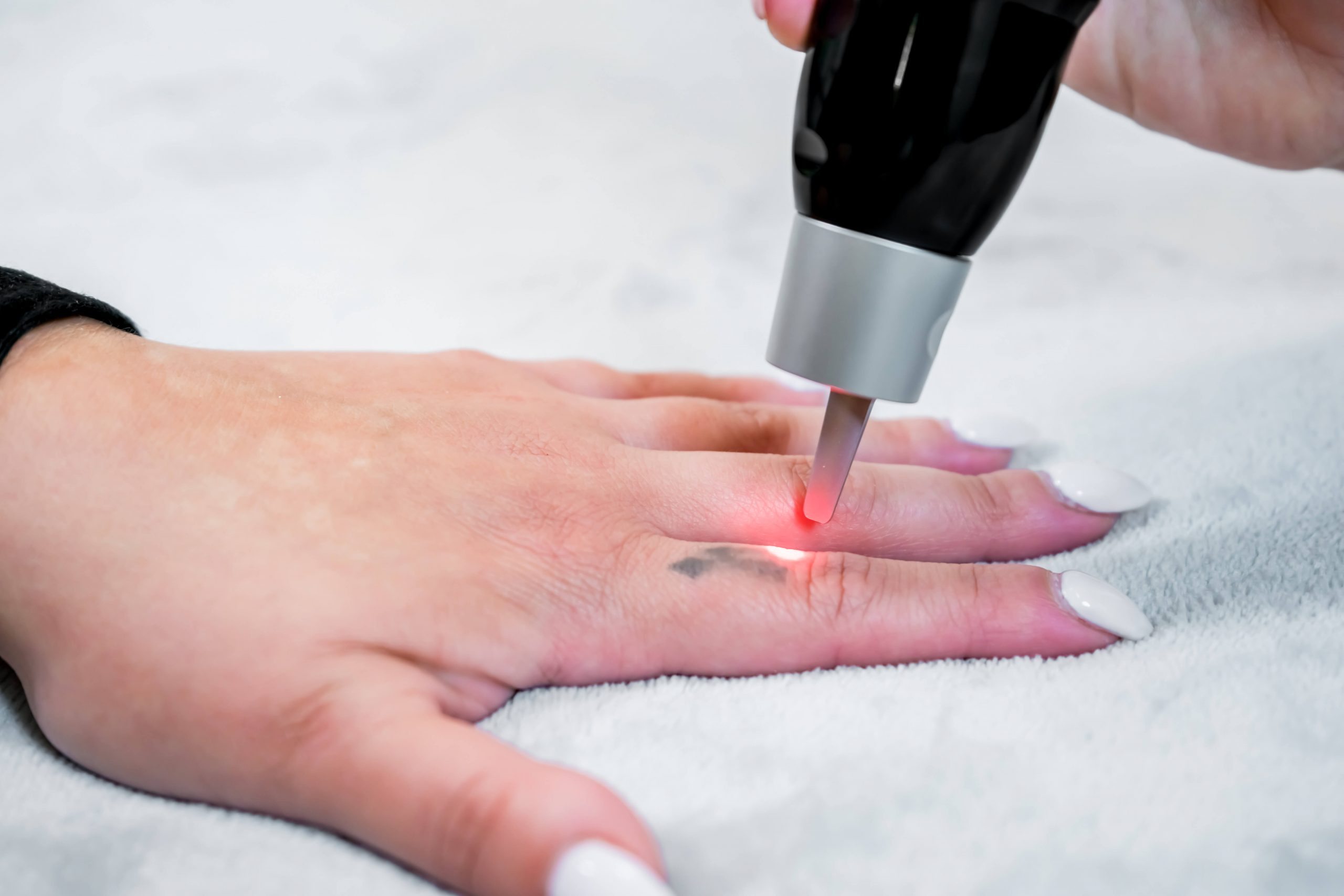 detatouage au laser sur le doigt d'une main