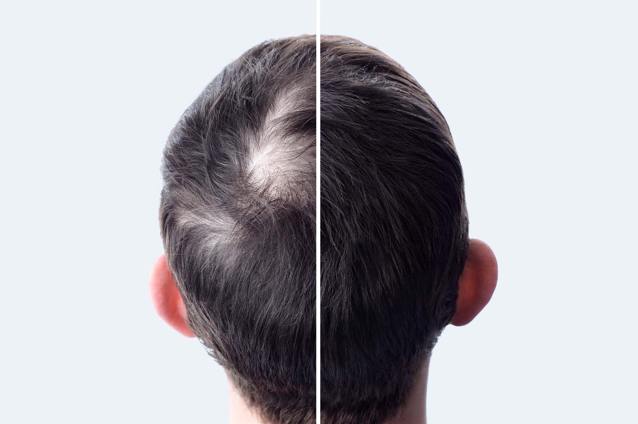 Perte de densité : comment densifier et épaissir ses cheveux ?