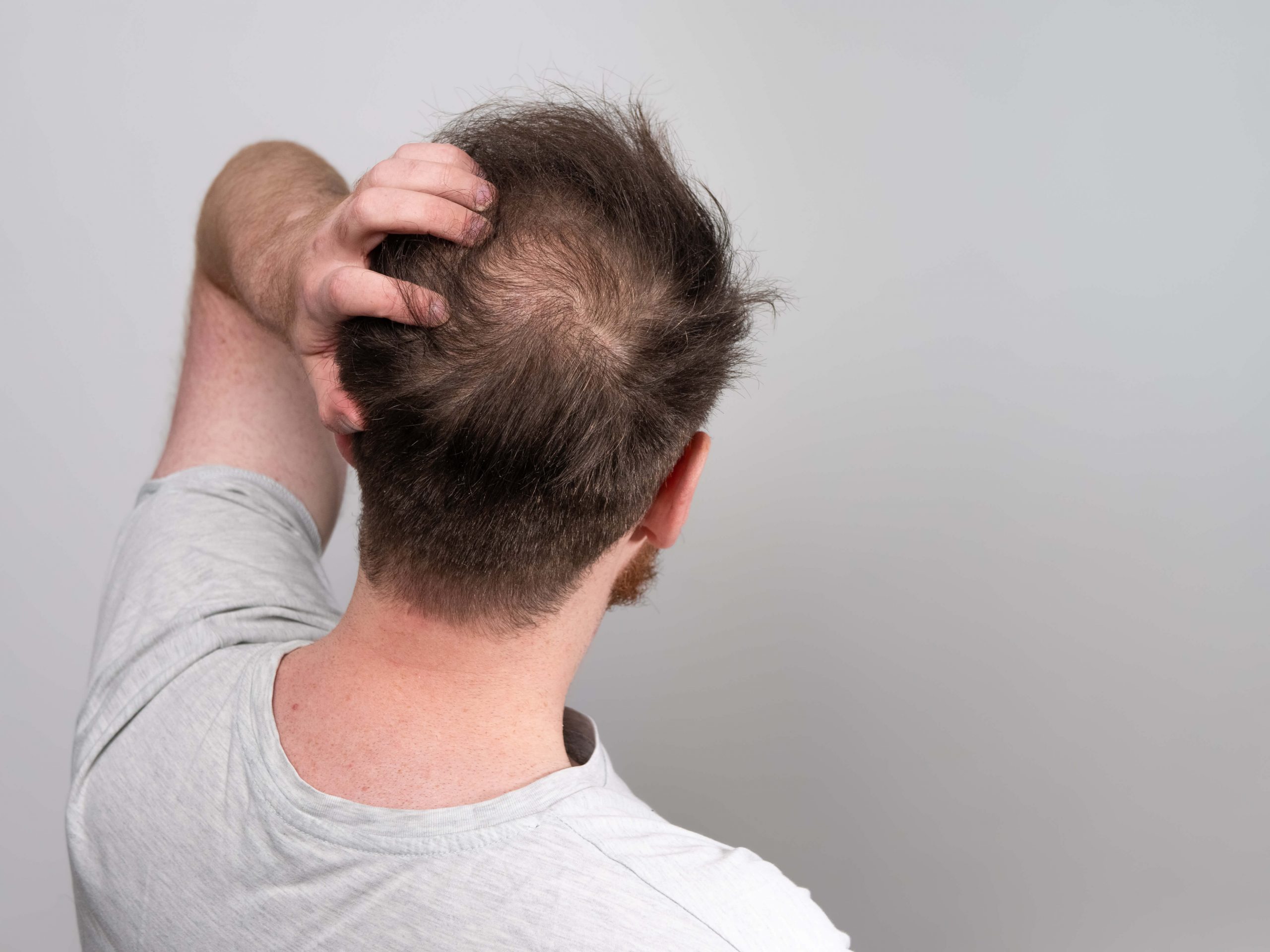 L'alopécie : Tout savoir sur la perte de cheveux