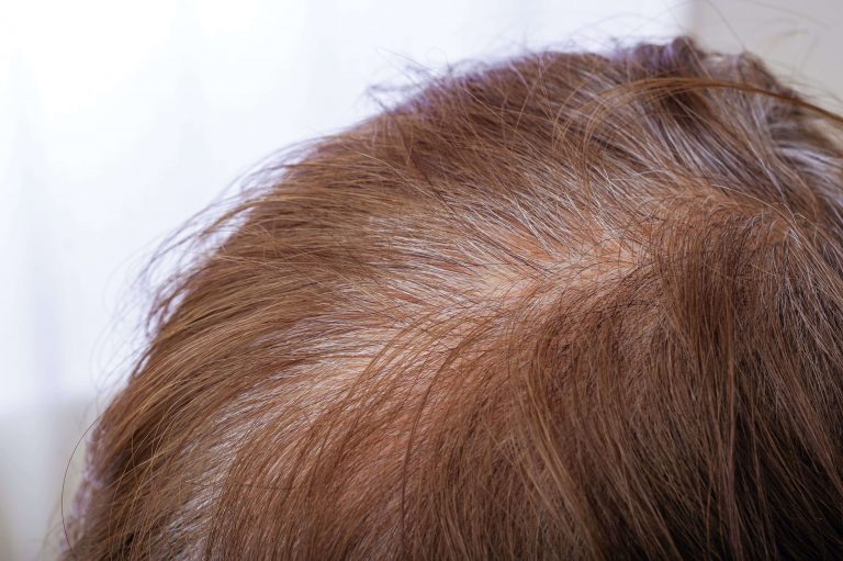Calvitie Vertex : Solutions de greffe de cheveux et autres traitements