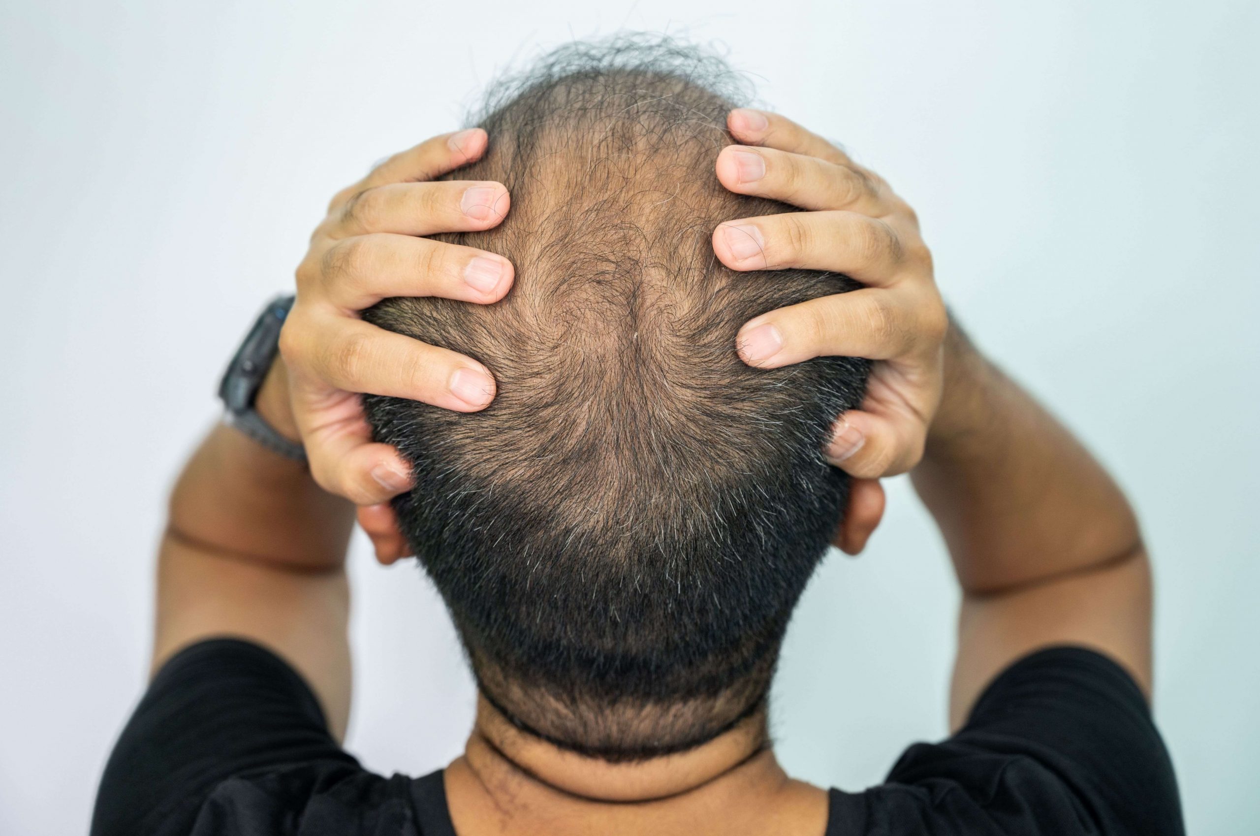 Les différents types de calvitie liés à la perte de cheveux