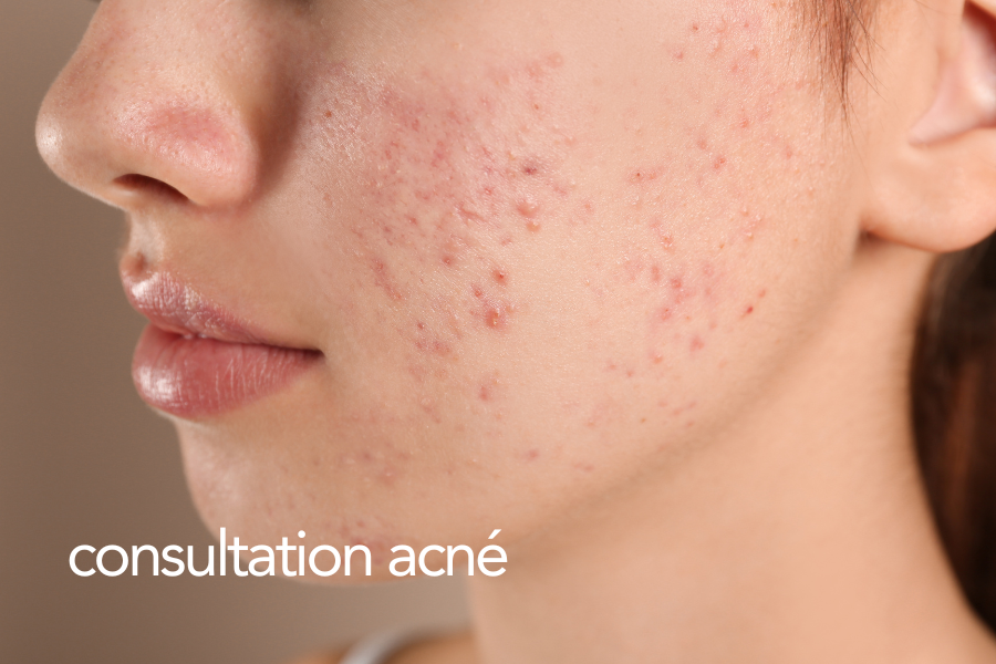 Une révolution des traitements anti-acné 6 consultation acne visage