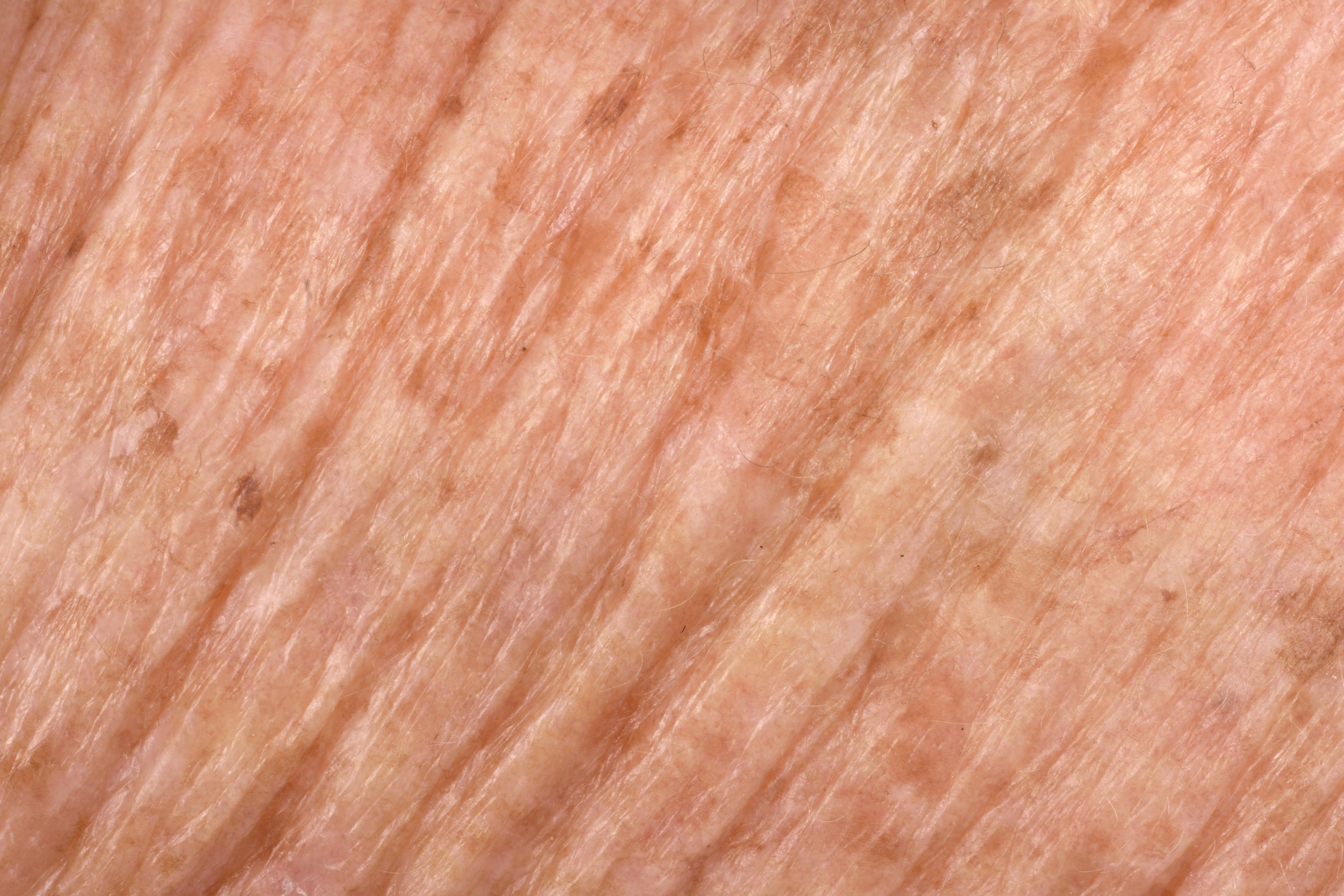 Peau seche hiver MEA 16