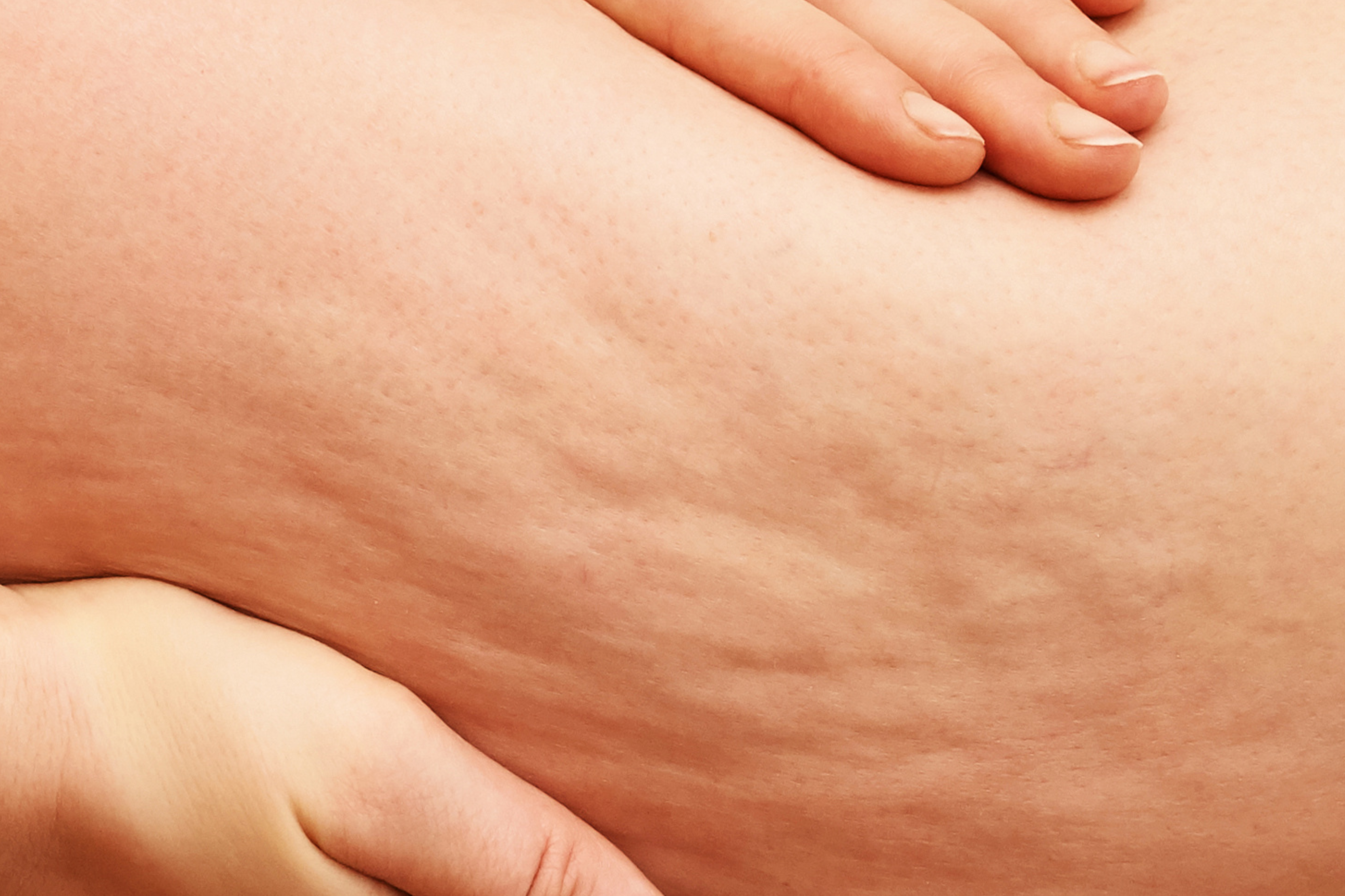 Peau seche hiver MEA 17