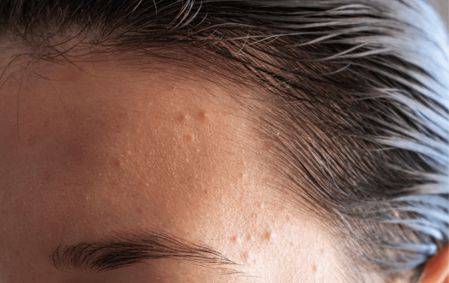 Alimentation et acné : quels aliments choisir contre l'acné 1 acne front
