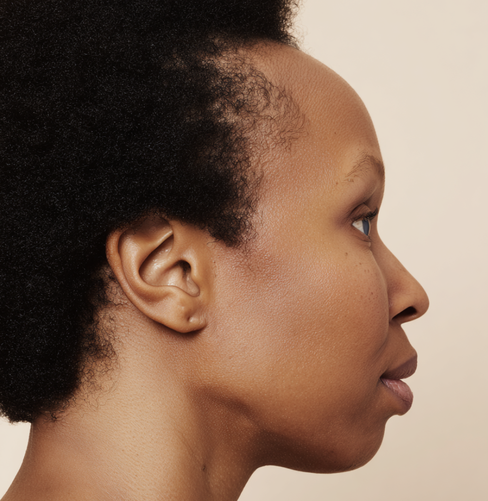 femme de profil atteinte d'une alopécie