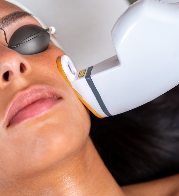 Imperfection printanière : pourquoi l'acné s’aggrave-t-elle au printemps et quelles sont les solutions ? 9 Séance de laser AviClear sur une femme