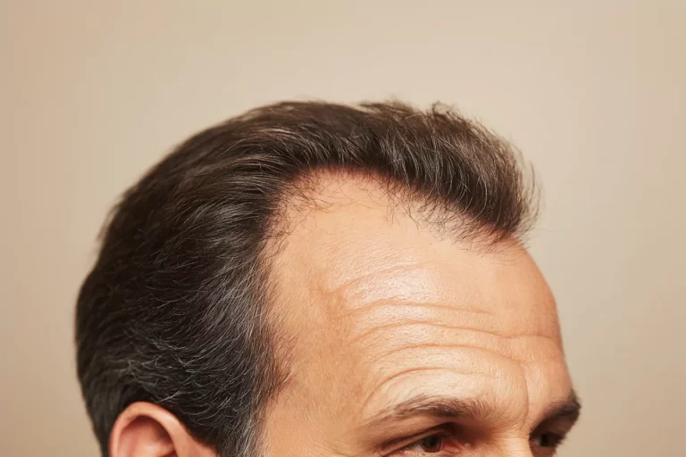 profil d'un homme qui a une calvitie