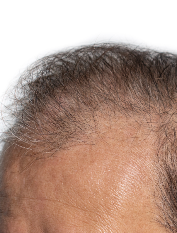 Un homme âgé qui a les cheveux clairsemés