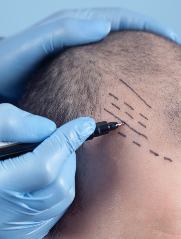 Séance de greffe FUE