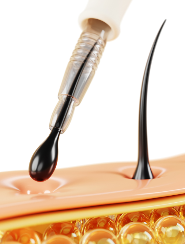 Schéma de la procédure d'une greffe FUT