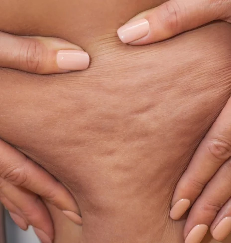 Une personne qui a de la cellulite au niveau des cuisses