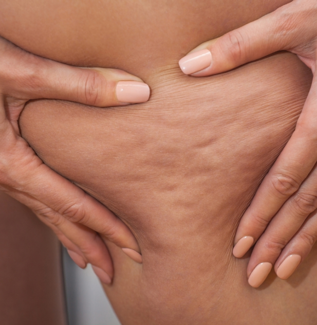 Cellulite - Cuisses 18 Une personne qui a de la cellulite au niveau des cuisses