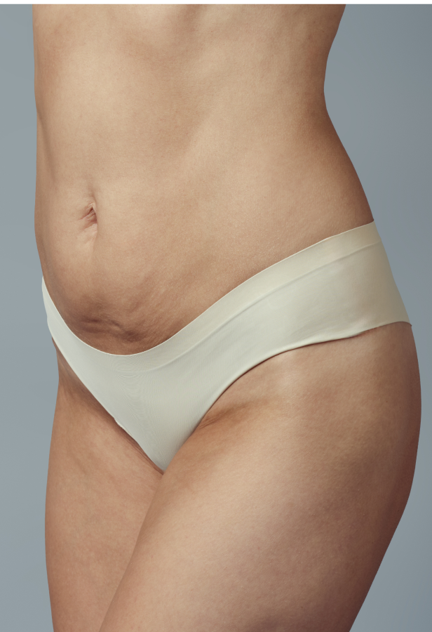 Cellulite - Ventre 7 Une personne qui a de la cellulite sur le ventre