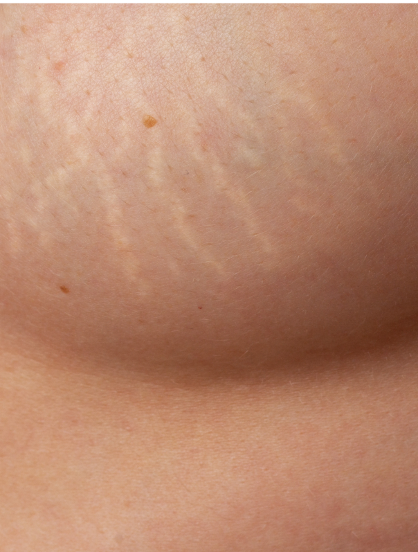 Zoom sur des vergetures sur les seins d'une femme