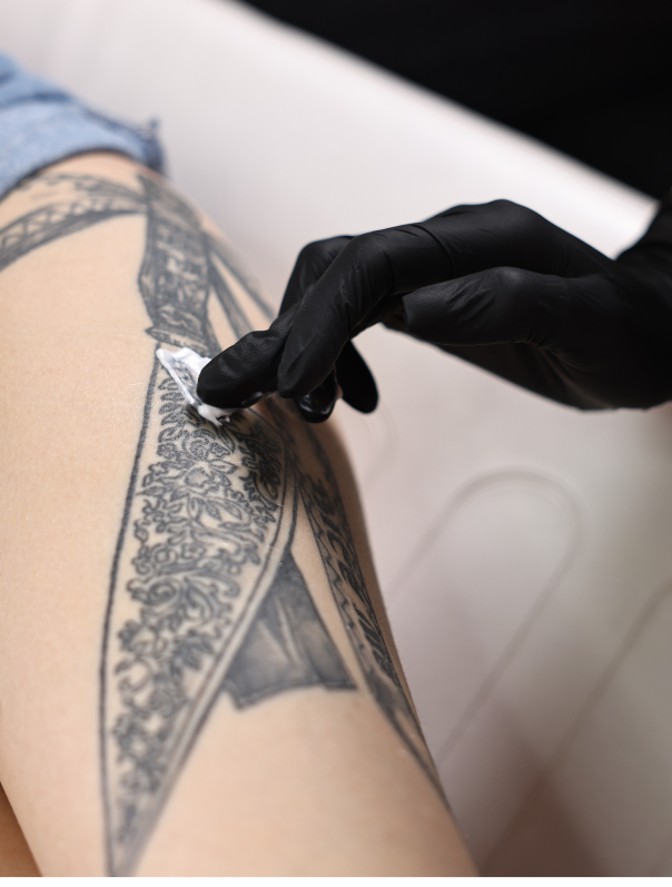 Le détatouage est-il douloureux ? 7 Cicatrisation d'un détatouage au laser