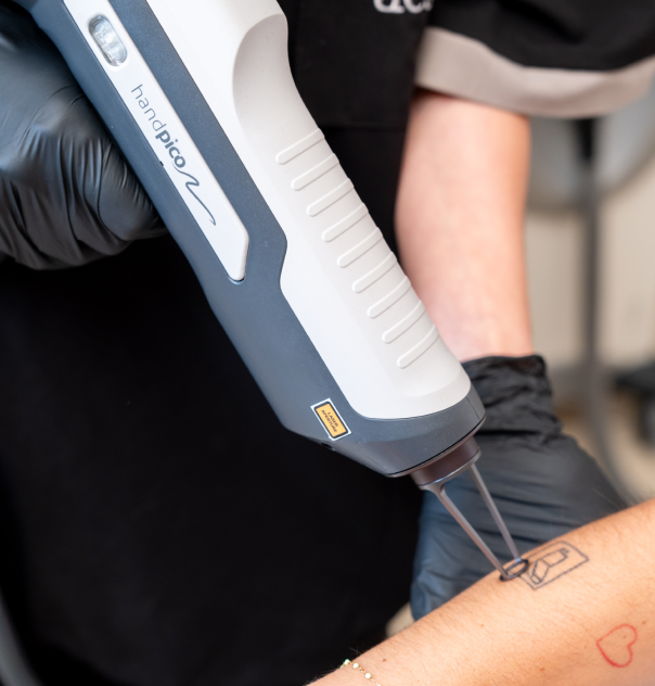 Séance de détatouage laser