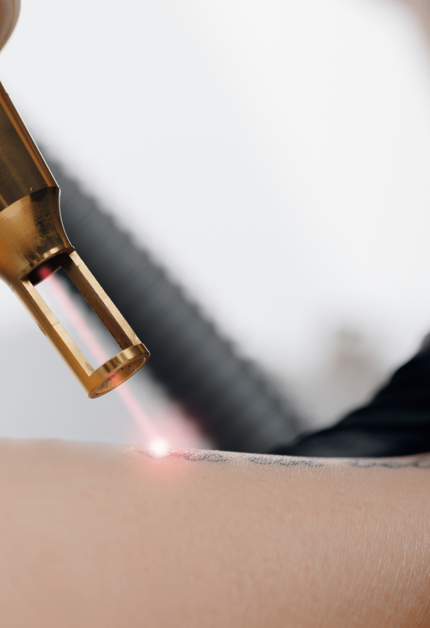 Les différentes techniques pour enlever un tatouage 5 Technique de détatouage au laser