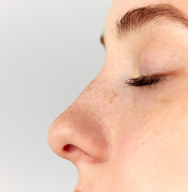 Rhinoplastie médicale 5 Zoom sur le nez refait d'une femme