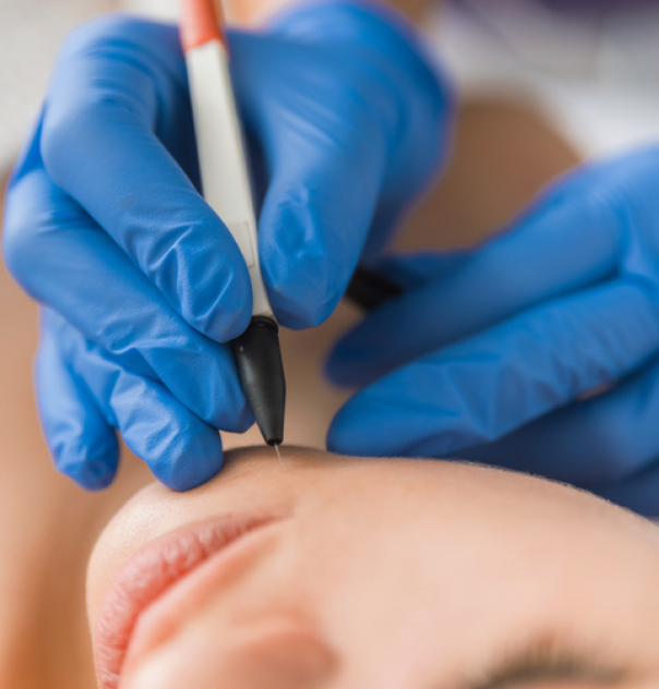 Séance d'épilation électrique par haute fréquence