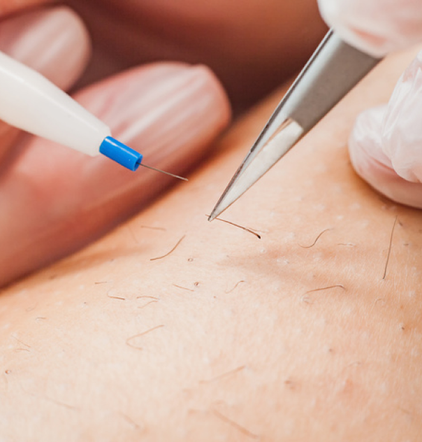Zoom sur une séance d'électrolyse
