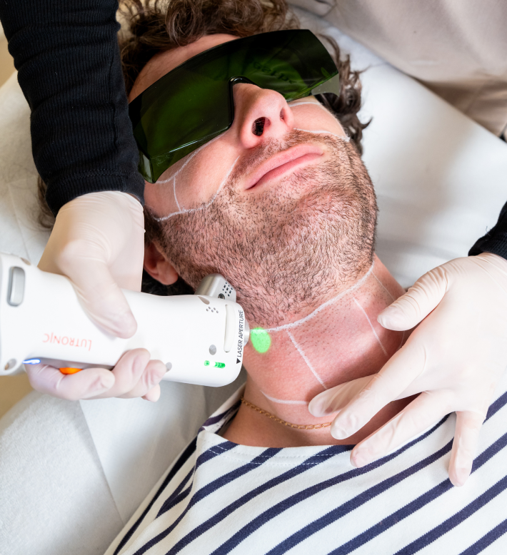Nos offres immanquables sur l'épilation laser pour homme à Paris ! 1 Séance d'épilation laser de la barbe