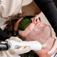 Séance d'épilation laser de la barbe avec le meilleur laser épilatoire