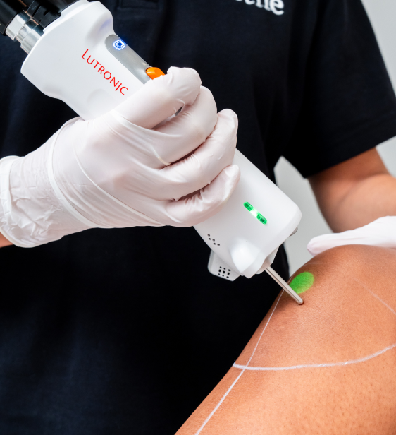 Séance d'épilation laser des jambes chez aesthé