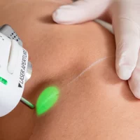 zoom sur peau pour epilation laser avec lumière du laser