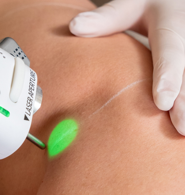zoom sur peau pour epilation laser avec lumière du laser