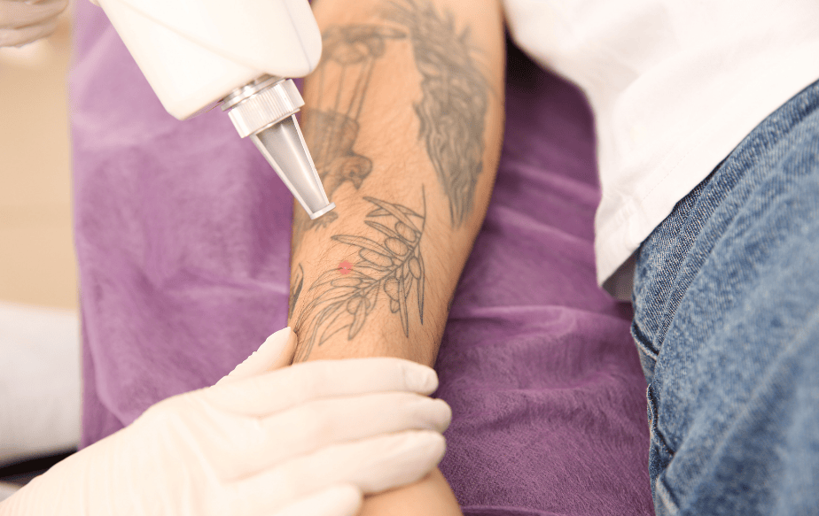 Épilation et tatouage : comment éliminer les poils sans abîmer sa peau 4 epilation laser tatouage