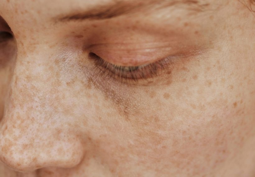 Visage gonflé : œdème, causes et solutions sur le long terme