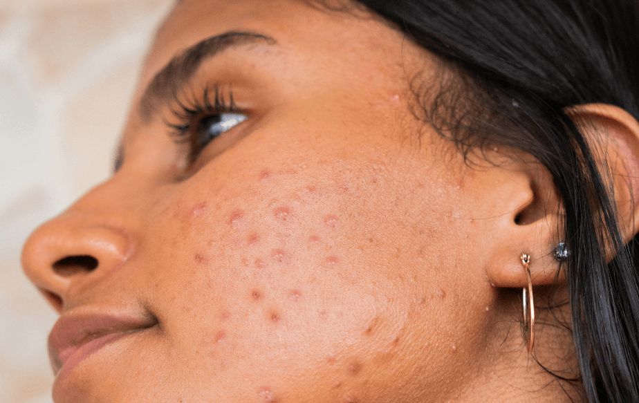Imperfection printanière : pourquoi l'acné s’aggrave-t-elle au printemps et quelles sont les solutions ? 4 femme boutons printemps