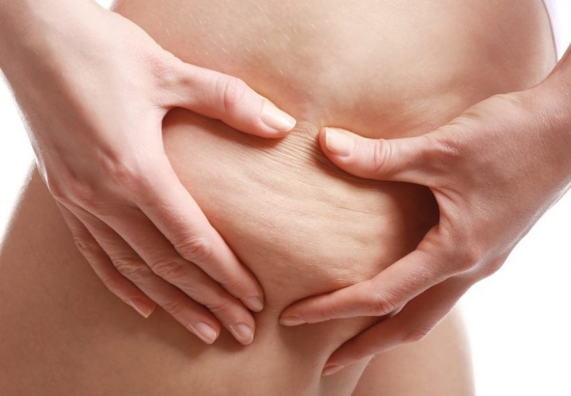 Cryolipolyse : comment optimiser les résultats et les effets de la cryolipolyse ? 3 une femme qui a de la cellulite qui se demande si la cryolipolyse est efficace dans le temps