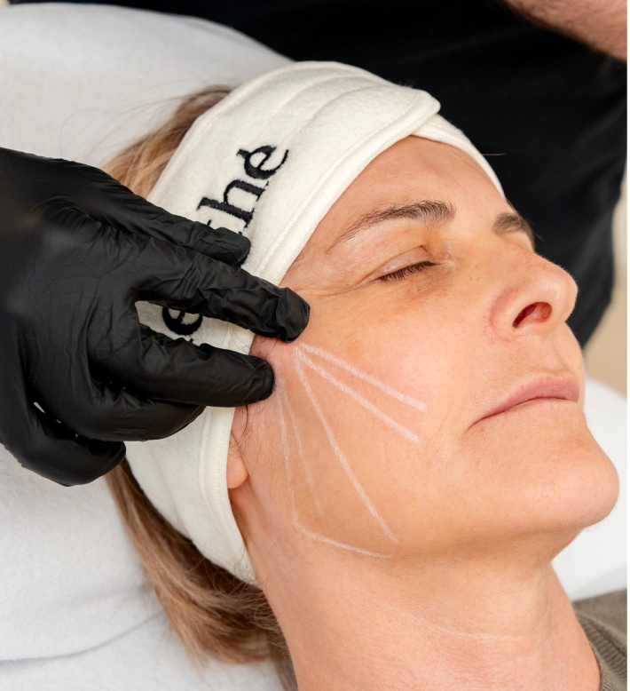 Les nouvelles tendances en matière de médecine esthétique en 2024 11 Séance de fils tenseurs sur une femme âgée