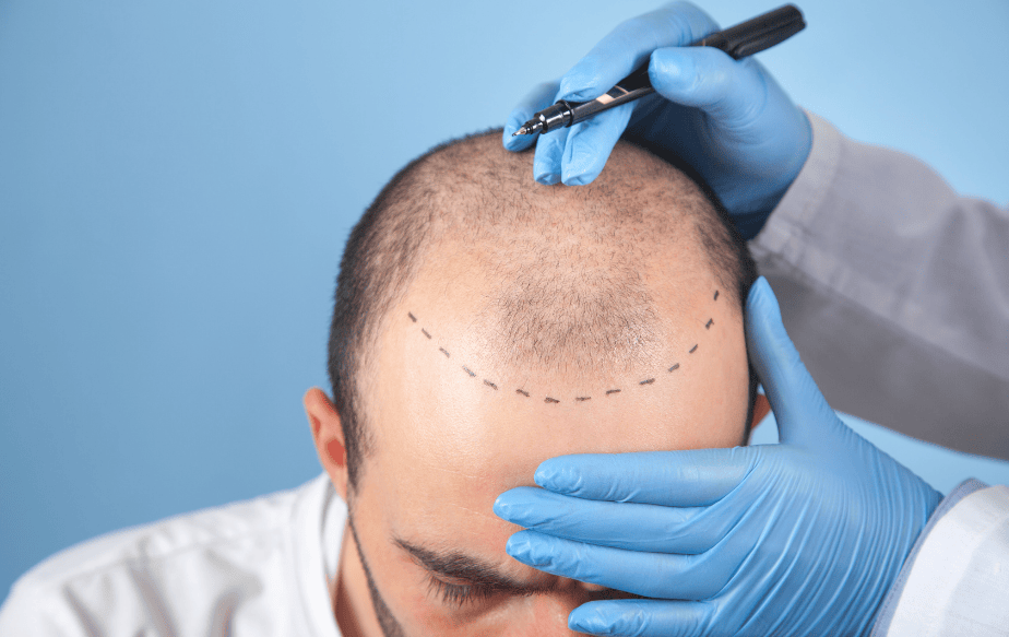 Quand peut-on faire une greffe de cheveux ? Notre guide complet