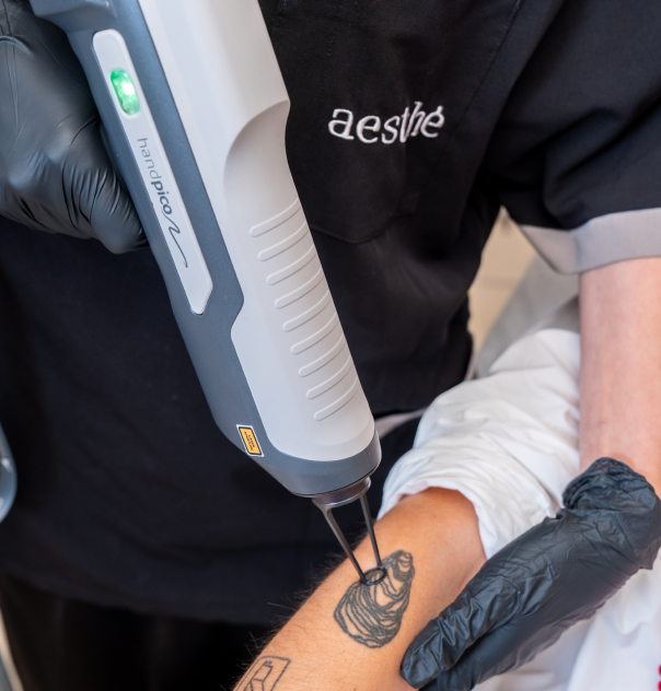 Séance de picoseconde chez aesthé