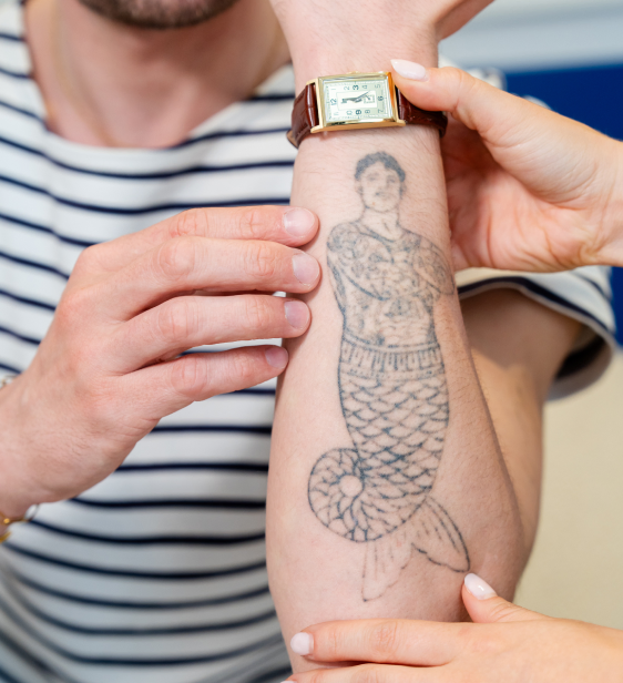 Un homme qui a fait du laser picoseconde sur u tatouage au niveau de son bras
