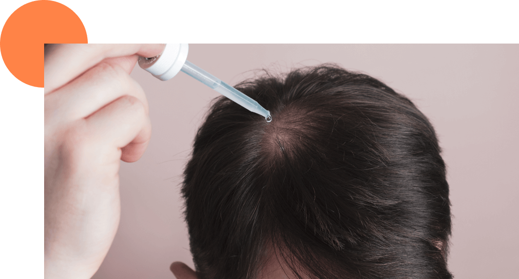 Le minoxidil, le traitement efficace contre la chute de cheveux