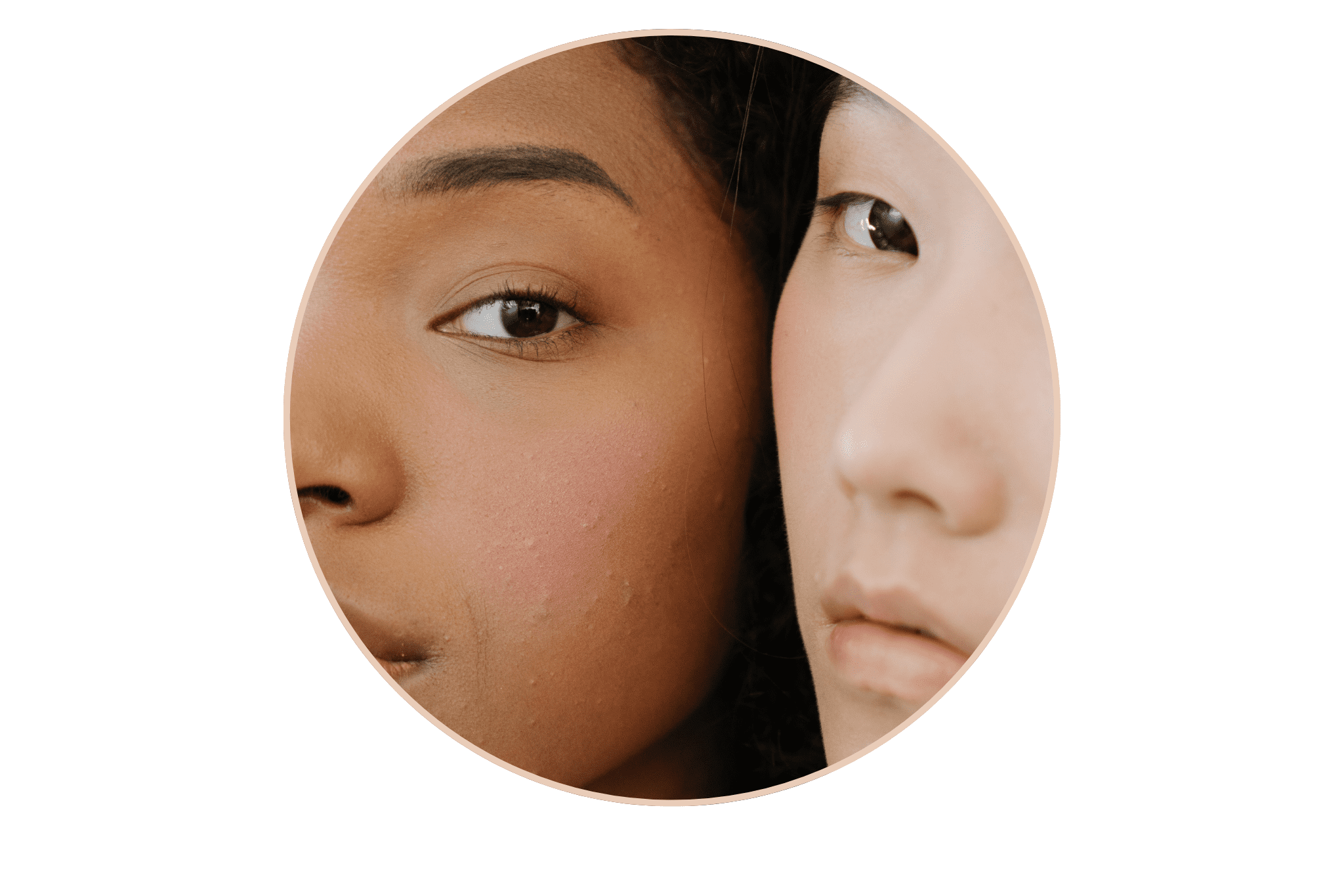 2 femmes avec une peau acnéique