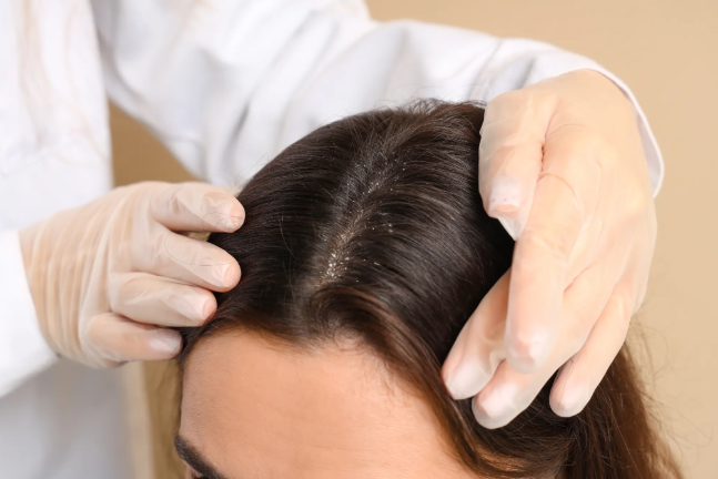 Examen du cuir chevelu pour identifier des pellicules grasses ou sèches