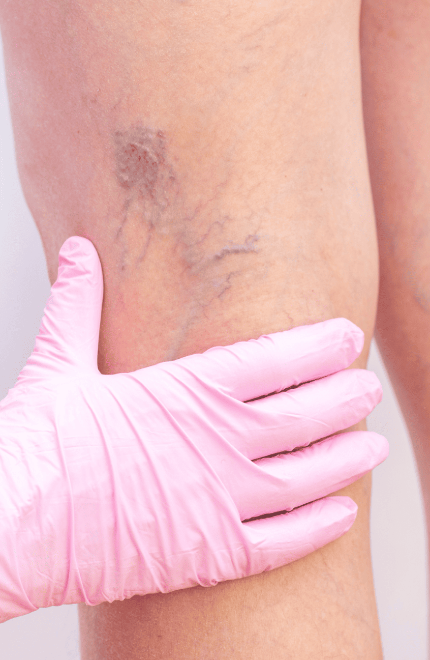 varices 1 17 Une personne qui va chez le médecin vasculaire pour faire analyser ses varices