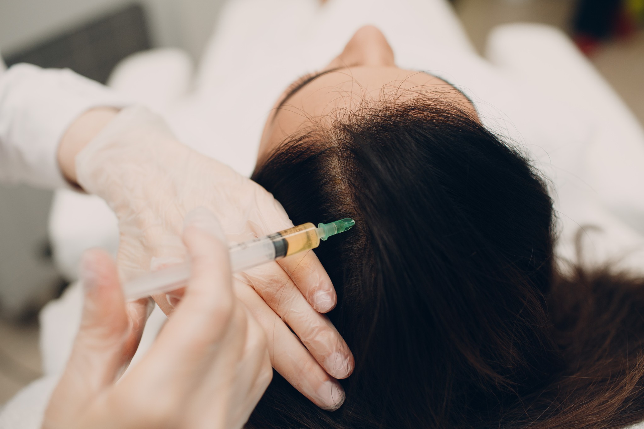 Les nouvelles tendances en matière de médecine esthétique en 2024 8 Séance de prp cheveux sur une femme qui perd ses cheveux