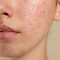 Une femme qui a de l'acné légère