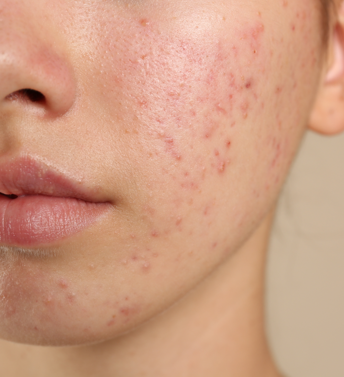 Une femme qui a de l'acné légère