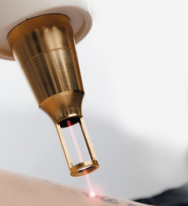 Technique laser nd:yag