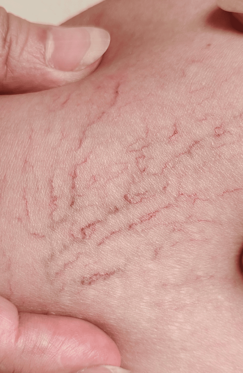 varices 1 16 Zoom sur des télangiectasies et des varices sur la jambe