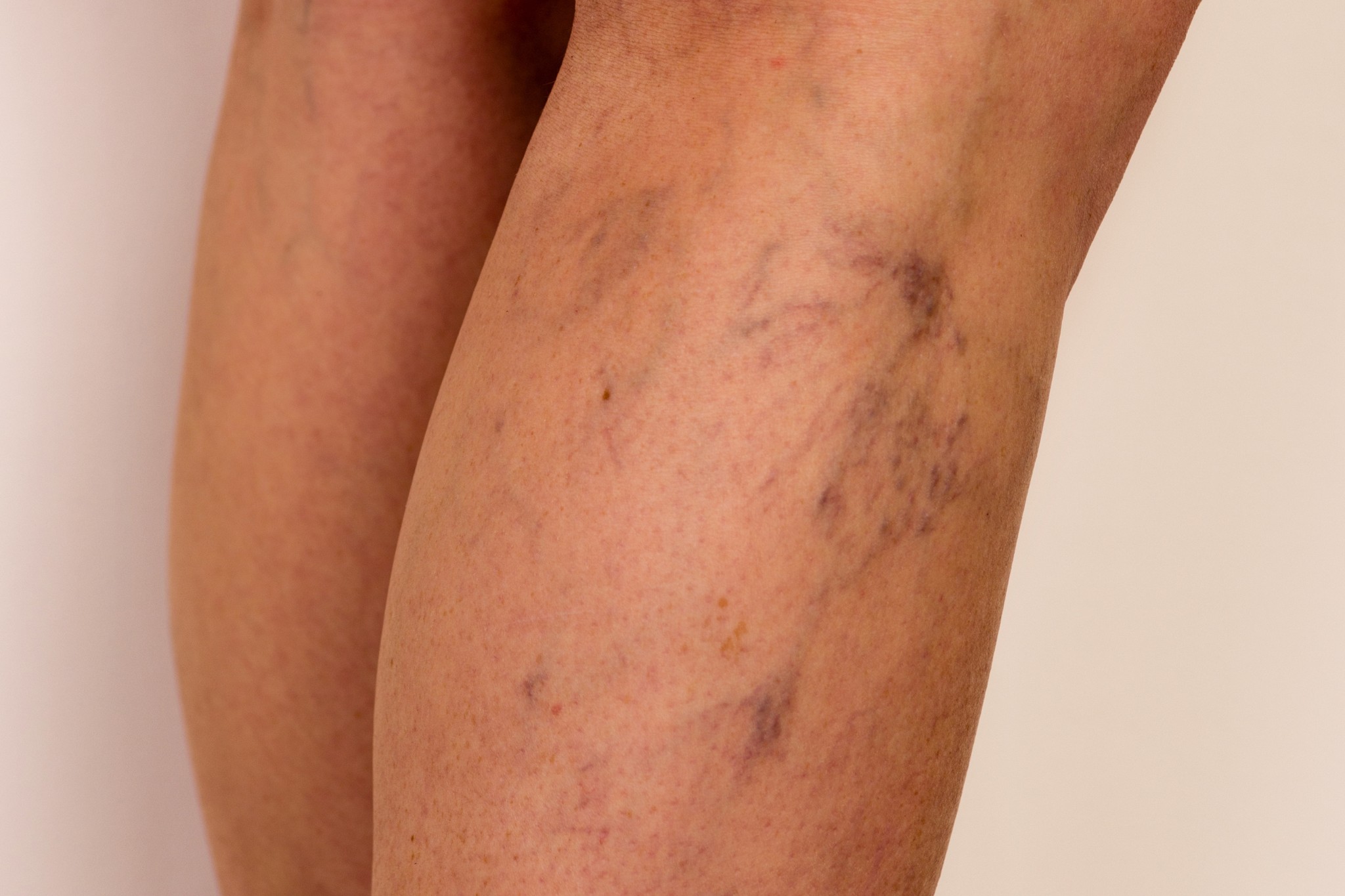 Varices des jambes 1 1 Une personne qui a des varices profondes sur ses jambes